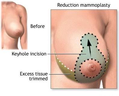 breast reduction mammoplasty