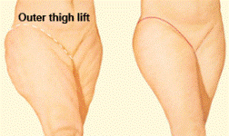 OUTER THIGH LIFT